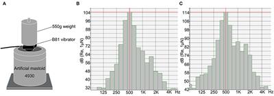 B81 Bone Vibrator-Induced Vestibular-Evoked Myogenic Potentials: Normal Values and the Effect of Age